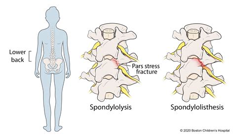 Spondylolysis and Spondylolisthesis | Boston Children's Hospital