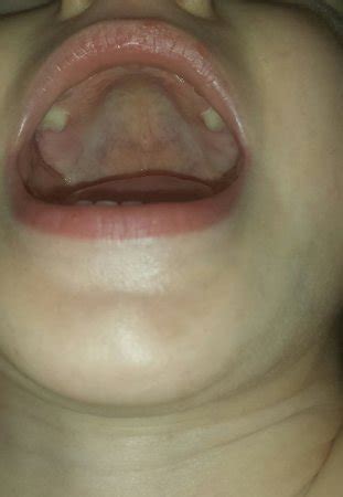 Submucous Cleft Palate? | BabyCenter