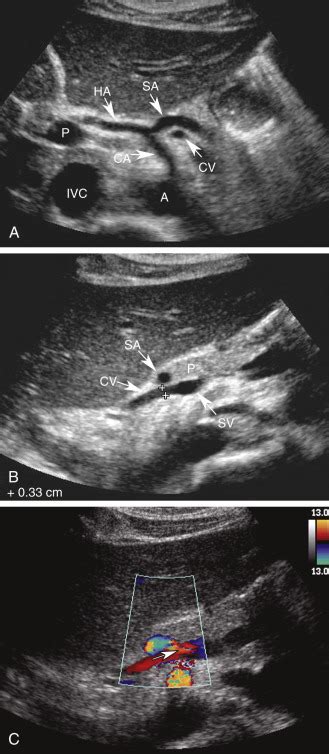 Hepatic Artery Ultrasound