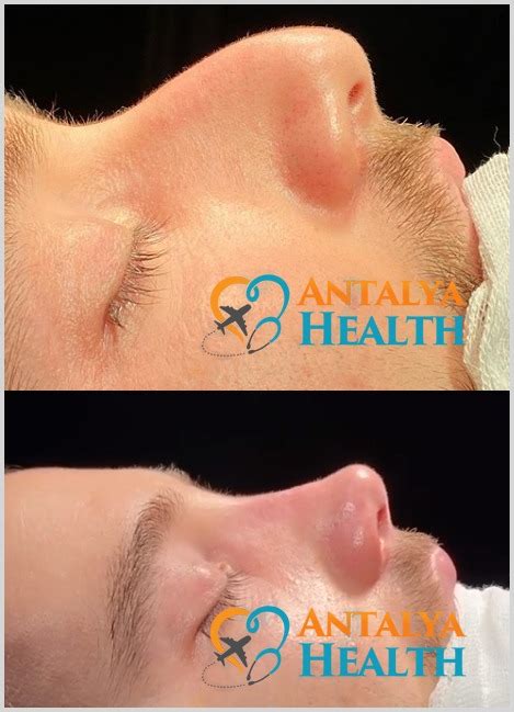 Rhinoplasty - Nose Job Turkey | Dental Clinic Turkey