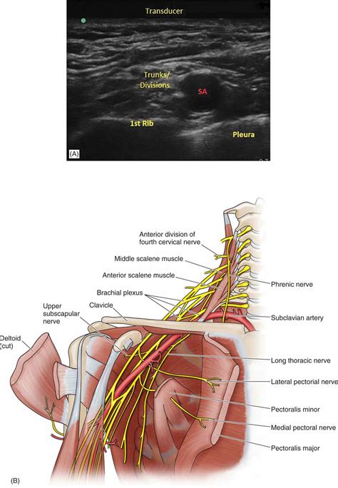 Supraclavicular and Infraclavicular Nerve Blocks | Anesthesia Key