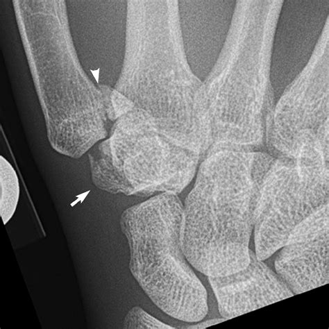 Carpal Bone Fracture