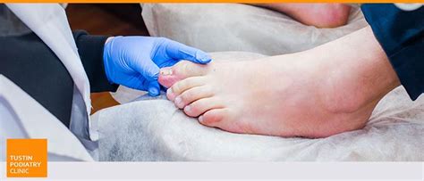 Toenail Fungus Laser Treatment Specialist Near Me in Tustin CA