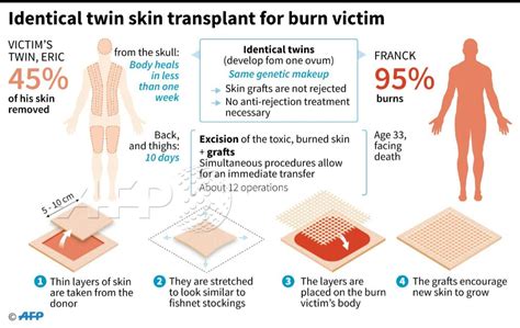 This is how doctors performed the pioneering skin graft process between two identical twins ...