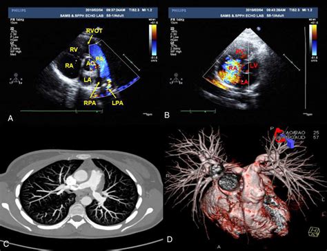 A–B) Echocardiography 6 months after symptom onset. It showed ...