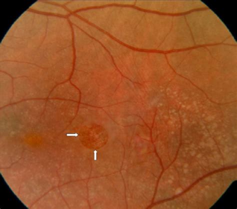 Full thickness macular defect following epiretinal membrane peel ...