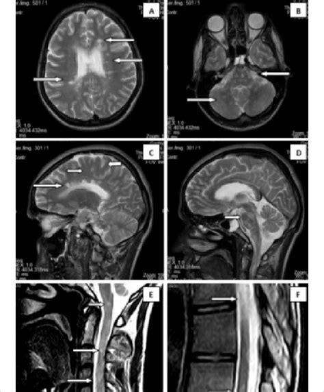 Demyelinating lesions in brain, brainstem and spinal cord in the ...