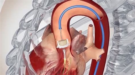 Transcatheter Aortic Valve Replacement (TAVR) | School of Medicine ...