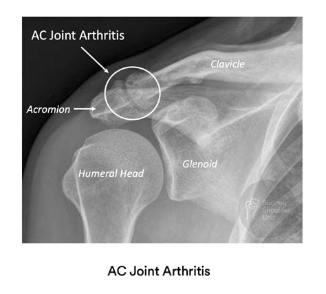 Severe Acromioclavicular Joint Osteoarthritis