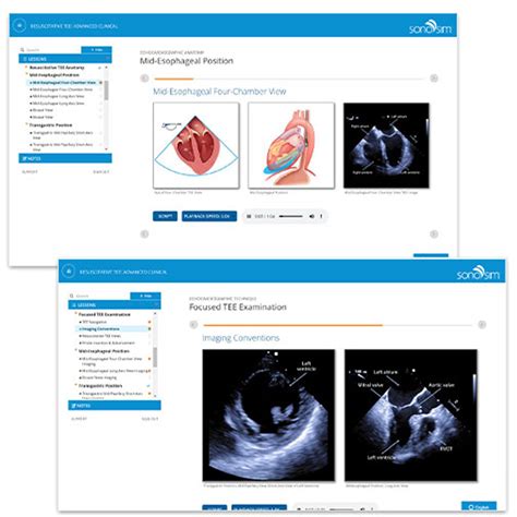 Transesophageal Echocardiogram TEE - Resuscitative TEE Ultrasound Training