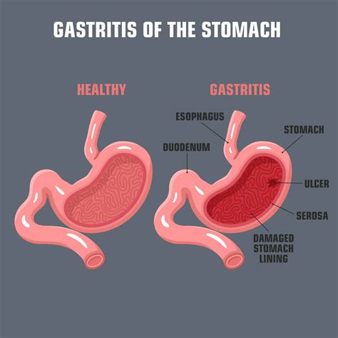 Is Your Gut Lining Compromised? - lilsipper