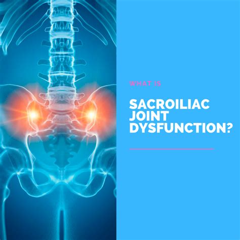 What Is Sacroiliac Joint Dysfunction? | New Jersey | Comprehensive ...