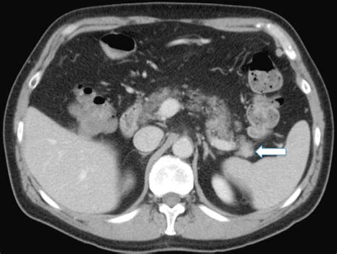 B. 50-year-old man with intrapancreatic accessory spleen. Axial CT scan... | Download Scientific ...