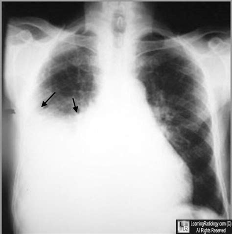 Learning Radiology - Hydropneumothorax