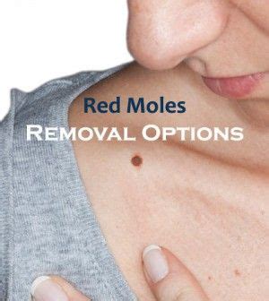 What Are Various Red Mole Removal Options? | Mole removal, Red mole, Red moles