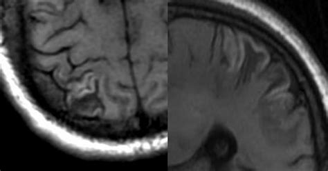 Dr Balaji Anvekar FRCR: Cortical laminar necrosis MRI