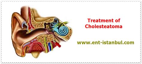 Cholesteatoma Definition, Symptoms, Complications And, 50% OFF