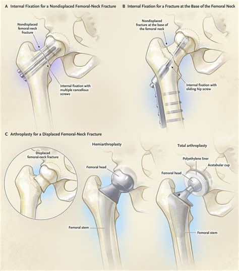 Intramedullary Nail Femur Physical Therapy Protocol - Nail Ftempo