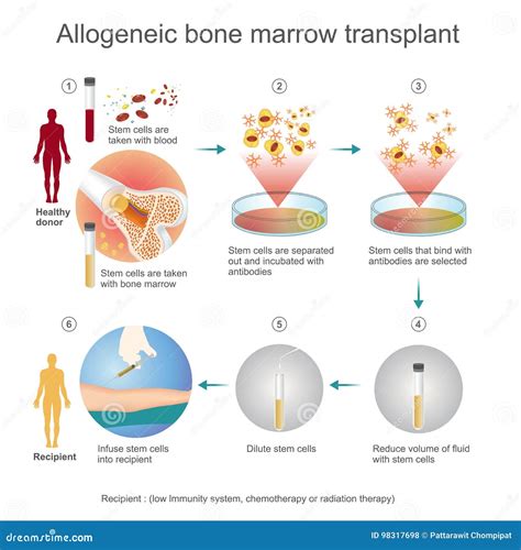 The Allogeneic Transplant Process. Stock Vector - Illustration of medicine, medical: 98317698