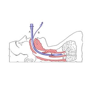 Tracheal intubation in critical care - expert guidelines - HealthManagement.org