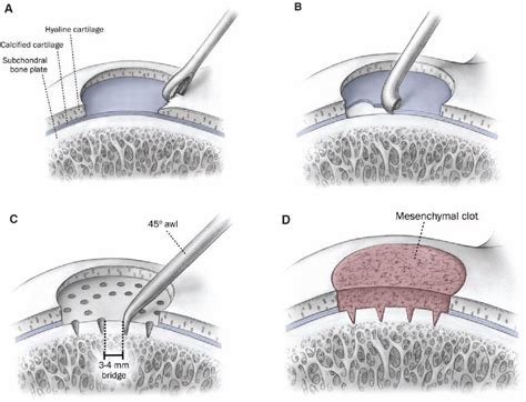 Figure 1 from Clinical Efficacy of the Microfracture Technique for Articular Cartilage Repair in ...