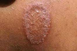 Herbs Blog: Natural way to treat ringworm