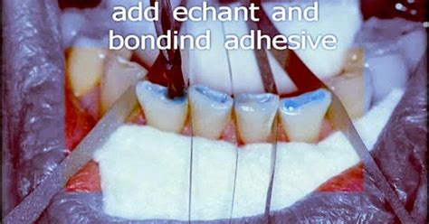 INCISAL EDGE REINFORCEMENT: Technique step by step - Dr. Buddy Mopper - Odonto-Tv