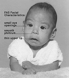 Fetal alcohol spectrum disorder - Wikipedia, the free encyclopedia