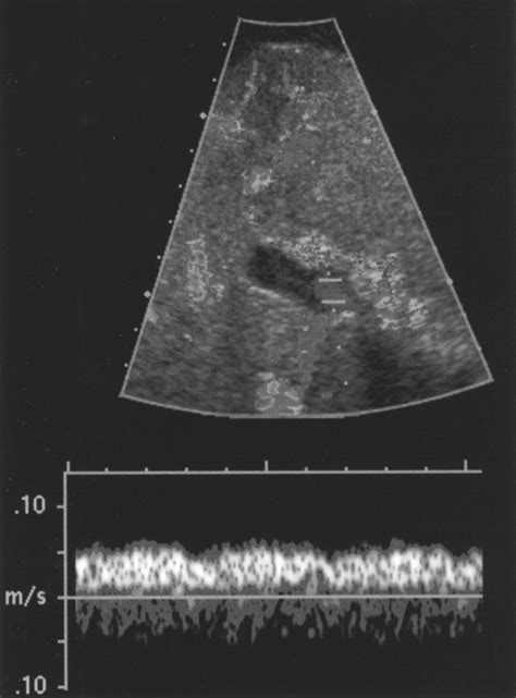 CT Signs of Hepatofugal Portal Venous Flow in Patients with Cirrhosis | AJR