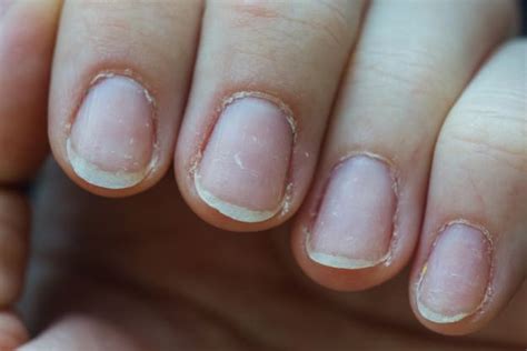 Suffer From Brittle Nails? | Returning Your Nails To Health