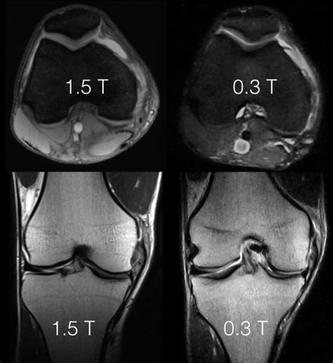 low field mri | coachingultrasound