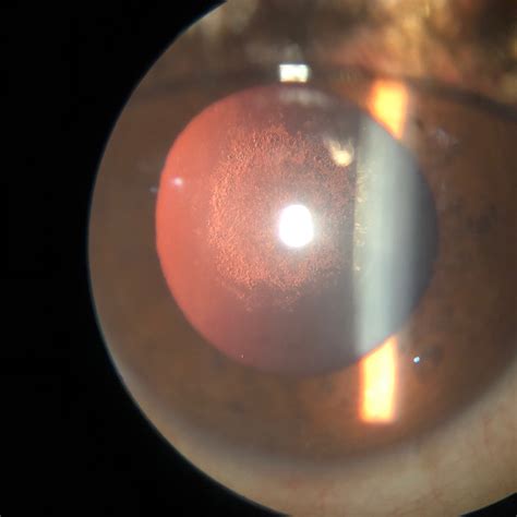 Posterior subcapsular cataract - American Academy of Ophthalmology