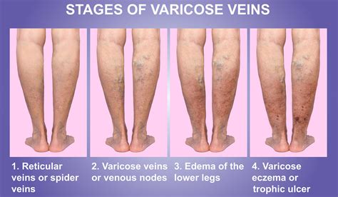 Varicose Veins – North Texas Vascular Center