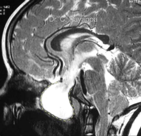 Skull Base Surgery in Children | Head & neck cancer surgeon