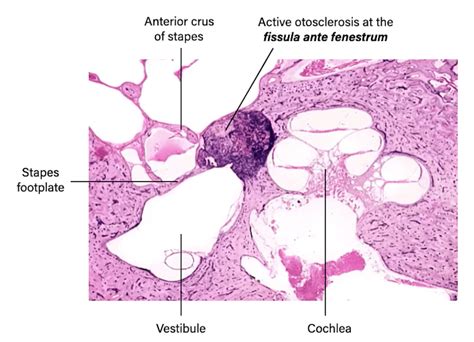 Otosclerosis Histology