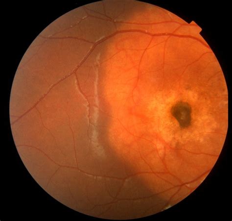 Choroidal Osteoma + CNV - Retina Image Bank