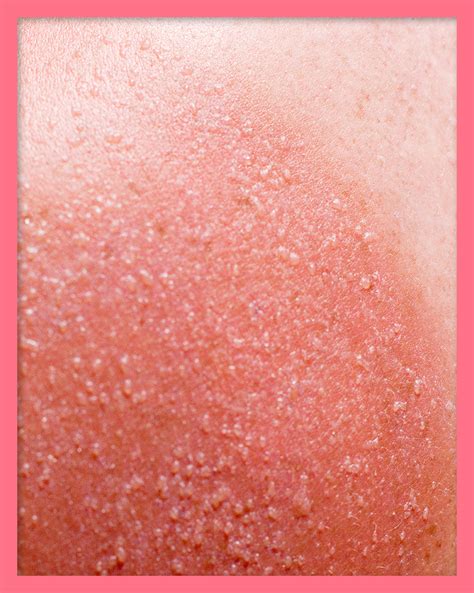 Sun Poisoning Rash Lovetoknow Heat Rash Sun Poisoning Rash Skin | My ...