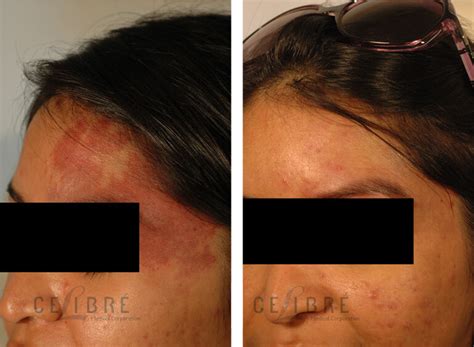 Vascular Birthmark Removal Before After Pictures 1