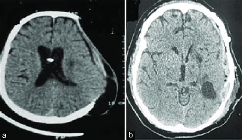 (a) Preoperative NCCT head (before cranioplasty) and (b) postoperative... | Download Scientific ...