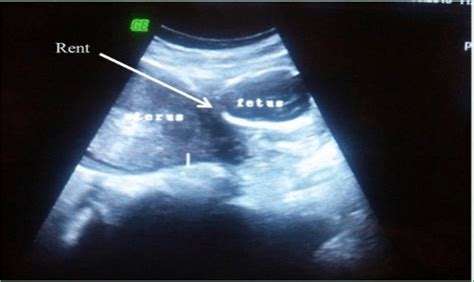 Ultrasound image showing empty uterus foetus seen anteriorly between... | Download Scientific ...