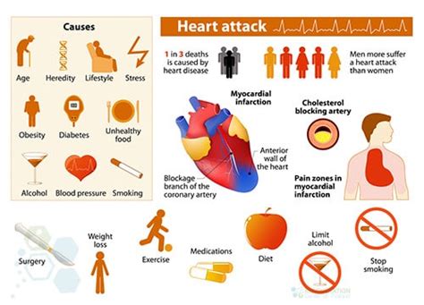 UC-MSC+ Cardiopoietic Stem Cell Therapy After Heart Attacks - MI