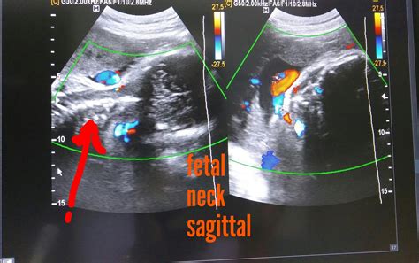 Ultrasound imaging: Nuchal cord