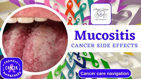 Understanding Mucositis: A Side Effect from Cancer Treatment | Symptoms ...