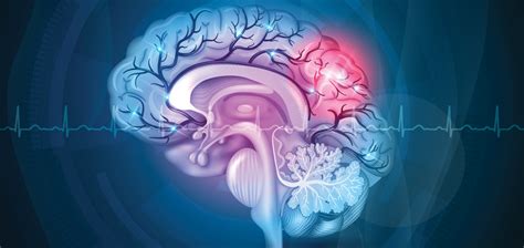 Secondary prevention of stroke