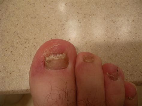 Terbinafine treatment for Onychomycosis, Week 2 | Flickr - Photo Sharing!