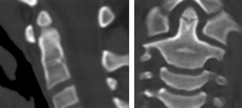 Normal Ossification Patterns of Atlas and Axis: A CT Study | American Journal of Neuroradiology