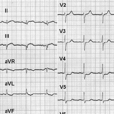 A, Left coronary artery angiogram showing an occluded LAD (arrow). B ...