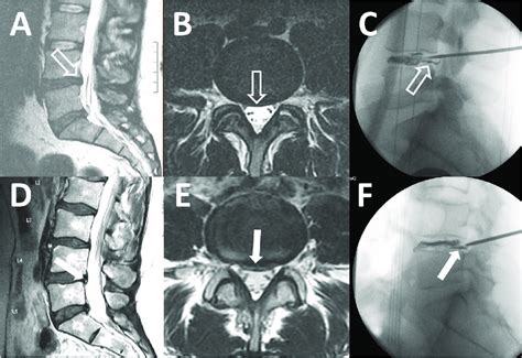 Subtle and obvious annular tears. T2 sagittal magnetic resonance ...