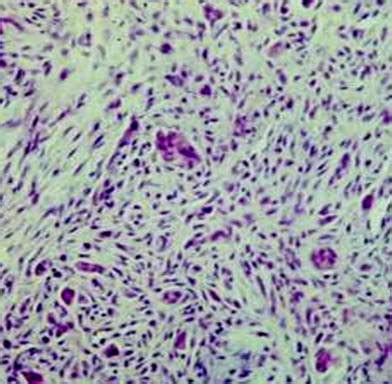 Hemangioendothelioma (hemangiosarcoma) - Pathology - Orthobullets