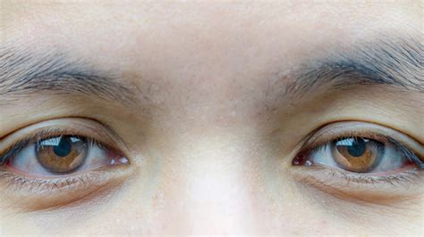 8 Causes of Ptosis and What You Can Do About It – The Amino Company